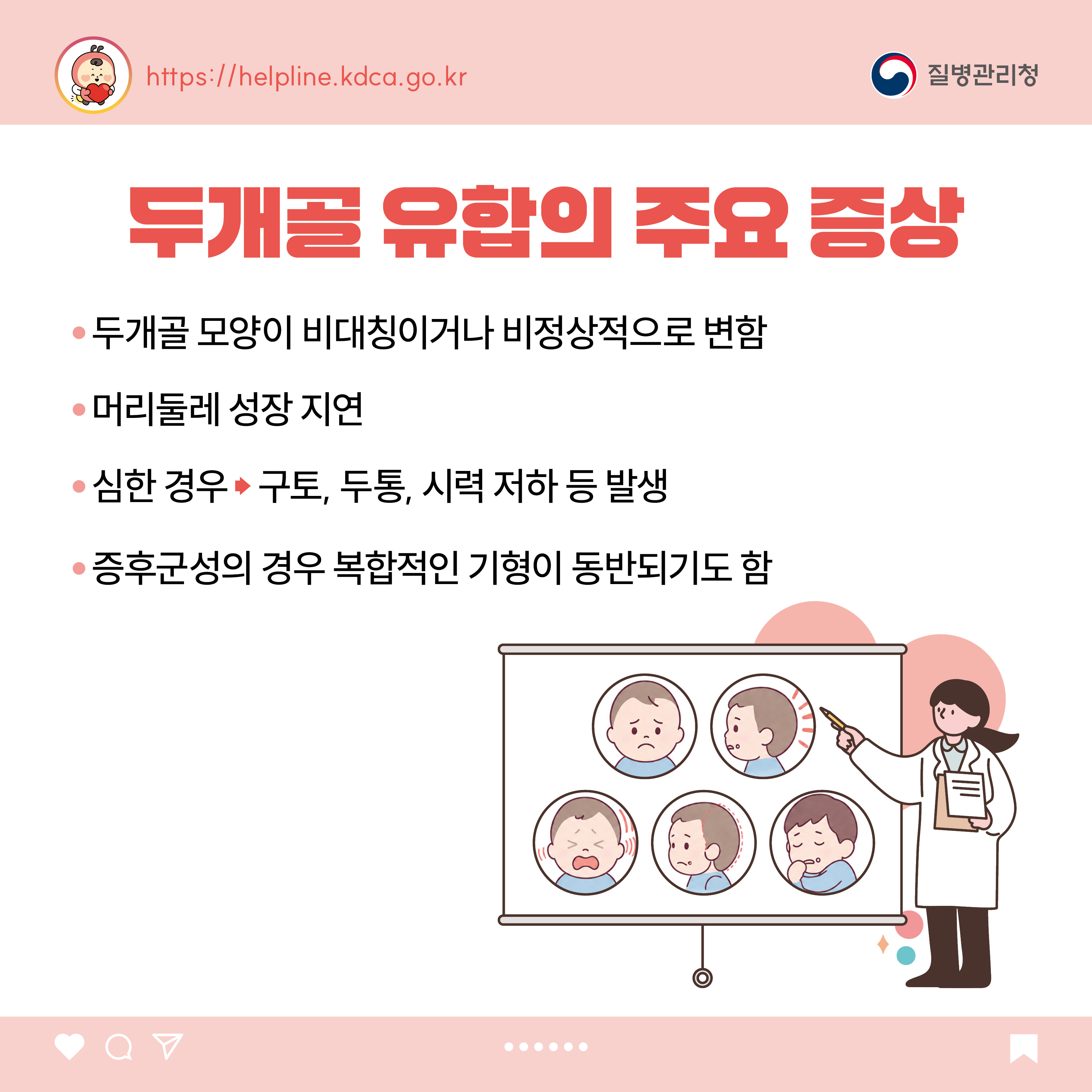 두개골 유합의 주요 증상  - 두개골 모양이 비대칭이거나 비정상적으로 변함 - 머리둘레 성장 지연 - 심한 경우 &rarr; 구토, 두통, 시력 저하 등 발생 - 증후군성의 경우 복합적인 기형이 동반되기도 함
